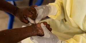 Un infirmier effectue un prelevement sur un enfant suspecte d'avoir contracte le virus mpox